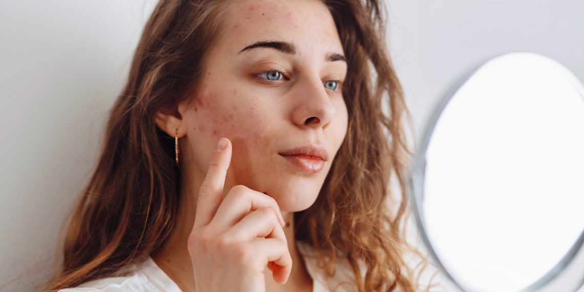 Os 14 melhores cremes para eliminar borbulhas e acne 47 MEJORES CREMAS ACNE