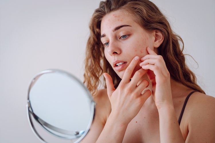 Te explicamos con la ayuda de expertos qué es el acné fúngico