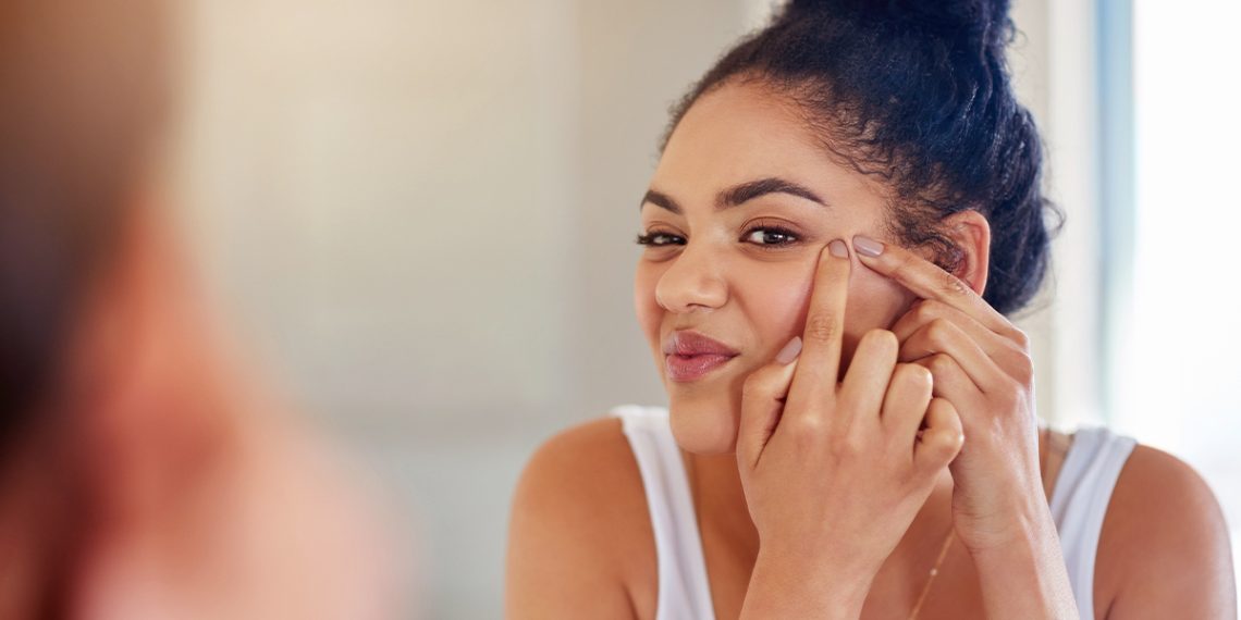 Te contamos cómo maquillar la piel con acné