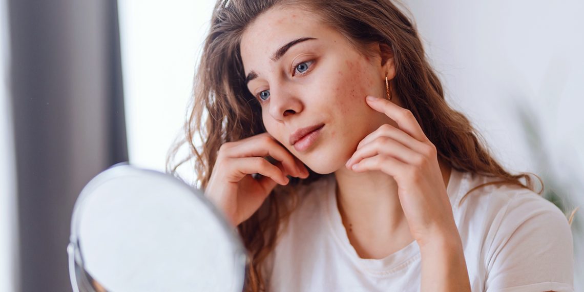 Te contamos qué es el acné conglobata y cómo puedes ponerle fin