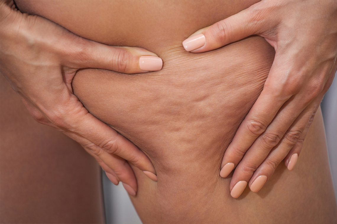 Celulitis en el embarazo: trucos para evitarla
