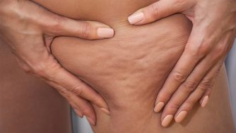 Celulitis en el embarazo: cómo puedes evitarla