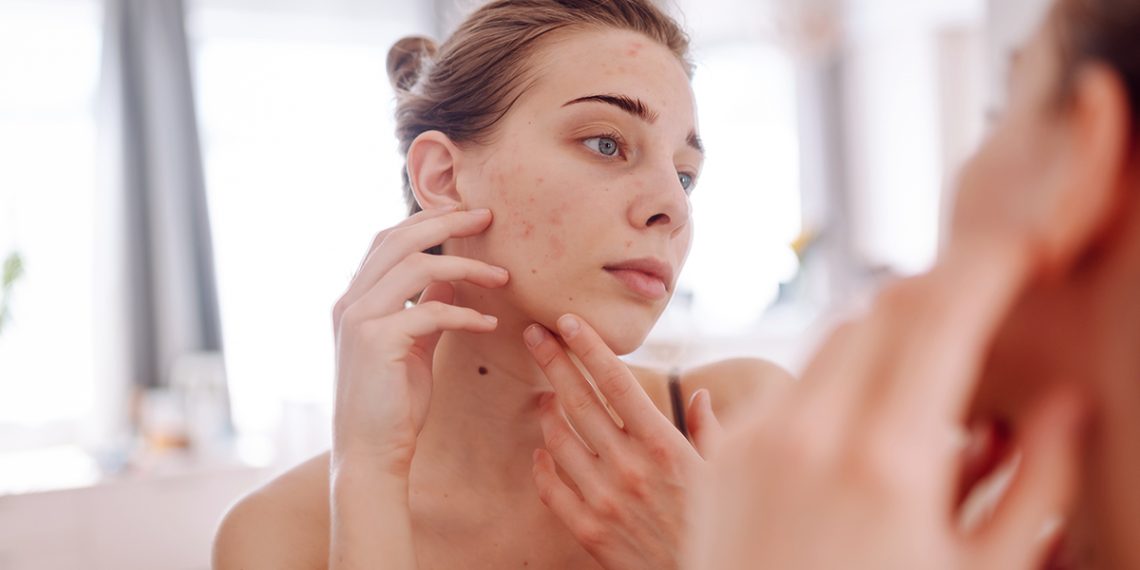 Te explicamos cómo eliminar marcas de acné