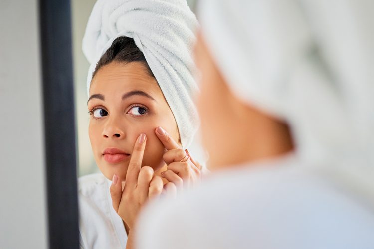 Skin Purge Que es y que beneficios tiene para mi piel