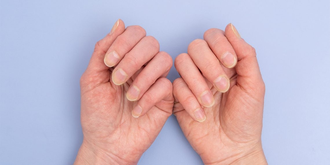 Elimina las manchas amarillas de tus dedos con estos trucos.