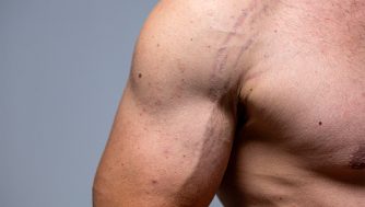 Estrías en los hombres: cómo eliminarlas