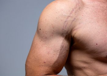 Estrías en los hombres: cómo eliminarlas y los mejores productos