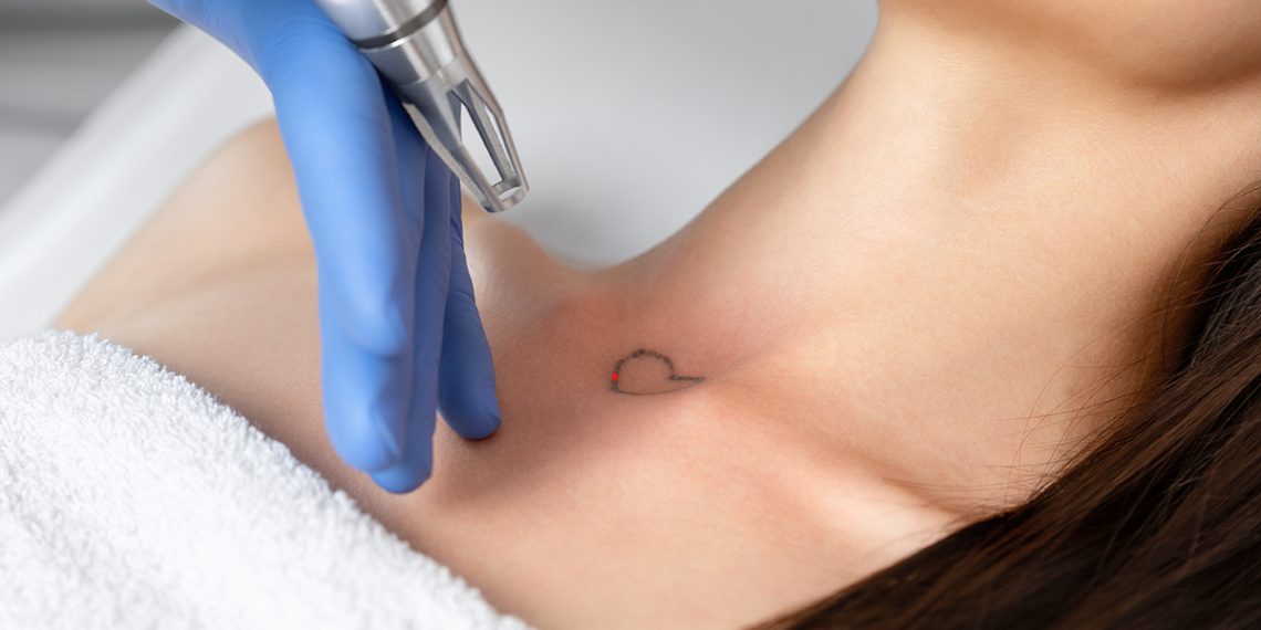 Te contamos cómo eliminar tatuaje permanente