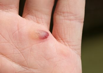 Ampolla de sangre: cómo eliminarlas