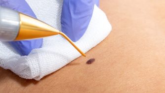 Verrugas: ¿qué son y por qué salen?