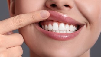 Gingivitis: qué es, por qué aparece y cuáles son sus síntomas