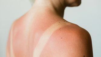 ¿Por qué me pongo rojo cuando tomo el sol?