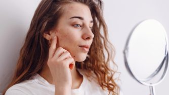Cicatrices del acné: por qué salen y cómo podemos prevenirlas según expertos