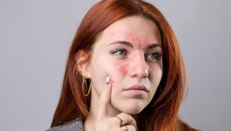 Cómo tratar la dermatitis seborreica en la cara