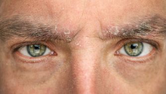 Cómo tratar la dermatitis seborreica en las cejas