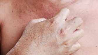Cómo tratar la dermatitis seborreica en el pecho