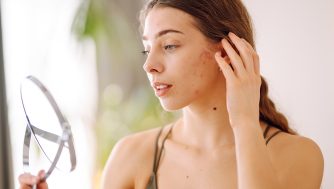 ¿Tienes piel con acné? Estas son las 4 mejores prebases