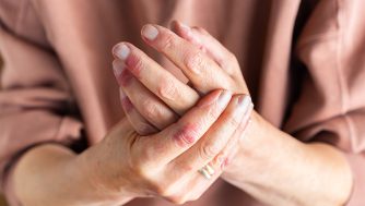 Cómo tratar la psoriasis en las manos