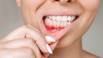 Motivos y causas por las que pueden salirte úlceras (y cómo tratarlas)