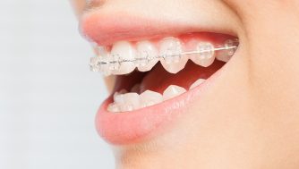 Si tienes ortodoncia, estos son los pasos que debes seguir para cepillarte bien los dientes