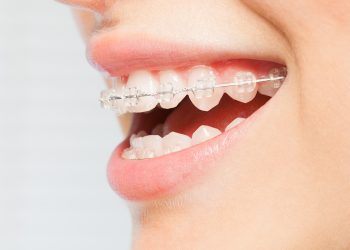 Cómo cepillar los dientes con ortodoncia